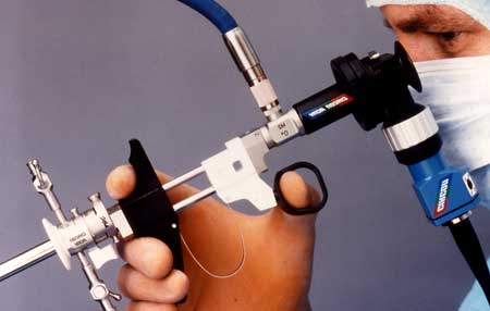 Histeroskopija - priprema, kada se i kako radi, oporavak