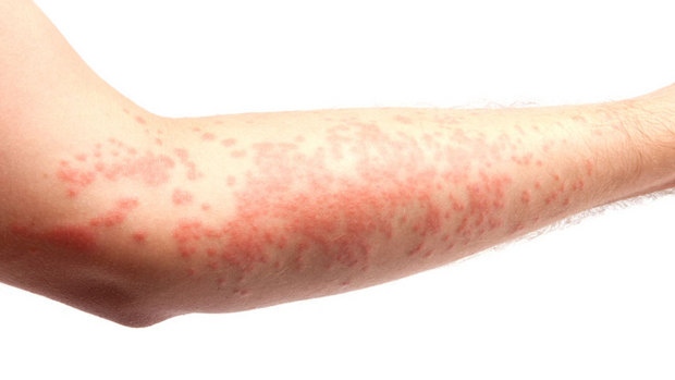 Alergija na sunce - simptomi, iskustva i lečenje