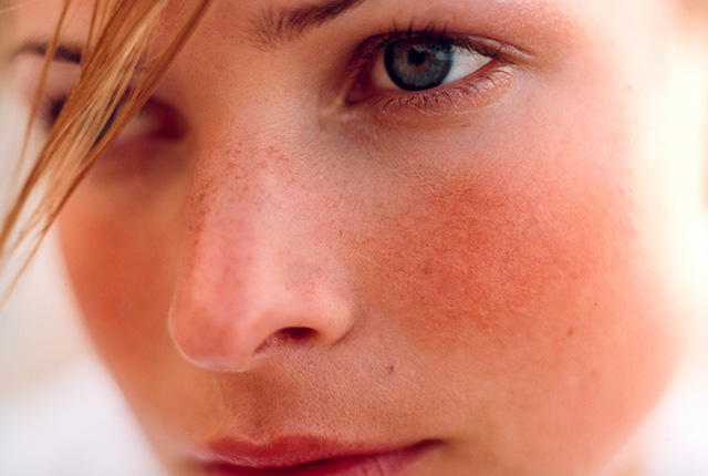 Kako ukloniti crvenilo na licu i obrazima - lečenje rozacee