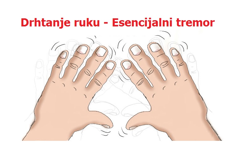 Drhtanje ruku esencijalni tremor – simptomi i prirodno lečenje