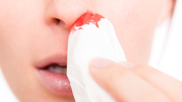 Krv iz nosa – uzrok, simptomi i prirodno lečenje