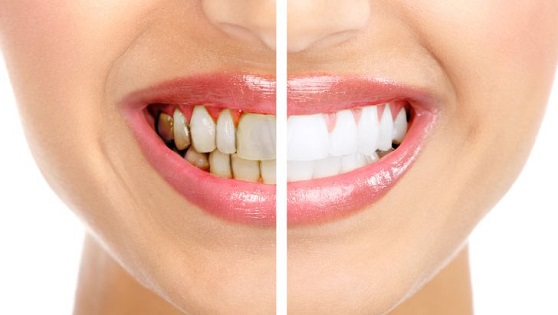 Upala zubnog mesa, gingivitis – uzrok, simptomi i lečenje
